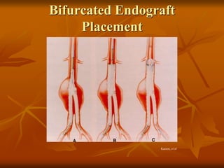 Bifurcated Endograft
Placement
Katzen, et al
 