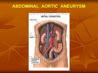 ABDOMINAL AORTIC ANEURYSM
 