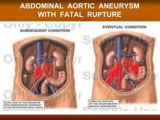 ABDOMINAL AORTIC ANEURYSM
WITH FATAL RUPTURE
 