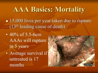AAA Basics: Mortality
 15,000 lives per year taken due to rupture
(13th leading cause of death)
• 40% of 5.5-6cm
AAAs will rupture
in 5 years
• Average survival if
untreated is 17
months
 