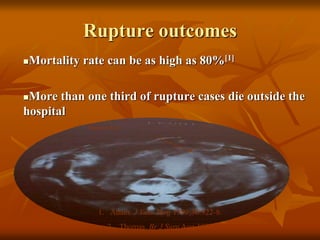 Rupture outcomes
Mortality rate can be as high as 80%[1]
More than one third of rupture cases die outside the
hospital
Ruptured AAA
1. Adam. J Vasc Surg 1999;30:922-8.
2. Thomas. Br J Surg Aug 1988
 