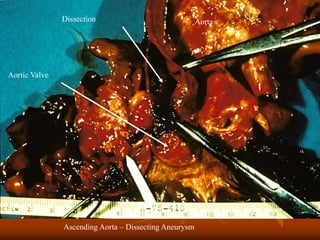Ascending Aorta – Dissecting Aneurysm
Dissection
Aortic Valve
Aorta
 