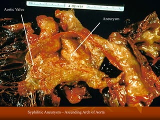 Syphilitic Aneurysm – Ascending Arch of Aorta
Aneurysm
Aortic Valve
 
