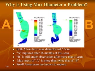 140
Why is Using Max Diameter a Problem?
Fillinger et al, Journal of Vascular Surgery April 2003 p726
 Both AAAs have max diameters of 5.5cm
 “A” ruptured after 18 months of this scan
 “B” is still under observation after more than 3 years
 Max stress of “A” is more than twice that of “B”
 Small Aneurysms are known to rupture
A B
 