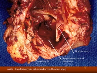 Axilla –Pseudoaneurysm, stab wound severed brachial artery
Brachial artery
Pseudoaneurysm with
blood clotAxillary fat
 