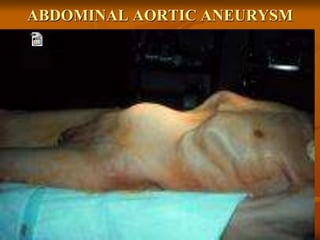 ABDOMINAL AORTIC ANEURYSM
 