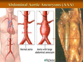 29
http://nusselt.me.cmu.edu/amongrad/summaries/AAAs.html
Abdominal Aortic Aneurysms (AAA)
2cm - 3cm
3cm - 10cm+
 