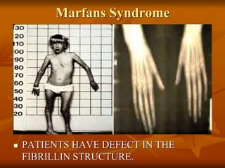 Marfans Syndrome
 KKKK
 PATIENTS HAVE DEFECT IN THE
FIBRILLIN STRUCTURE.
 