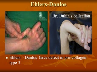 Ehlers-Danlos
 Ehlers – Danlos have defect in pro-collagen
type 3
 