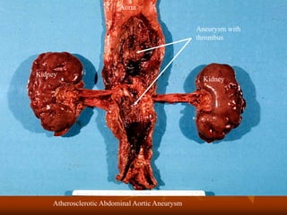 Atherosclerotic Abdominal Aortic Aneurysm
Aneurysm with
thrombus
Kidney
Kidney
Aorta
 