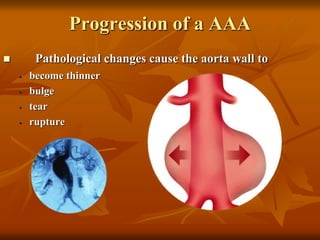 Progression of a AAA
 Pathological changes cause the aorta wall to
• become thinner
• bulge
• tear
• rupture
 