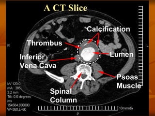61
Lumen
Thrombus
Calcification
Inferior
Vena Cava
Spinal
Column
Psoas
Muscle
A CT Slice
 