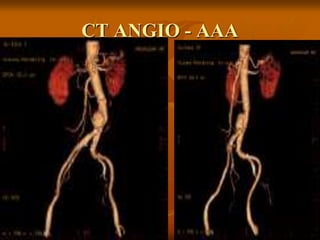 CT ANGIO - AAA
 