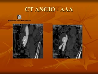 CT ANGIO - AAA
 