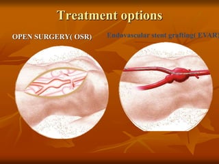 Treatment options
Endovascular stent grafting( EVAR)OPEN SURGERY( OSR)
 
