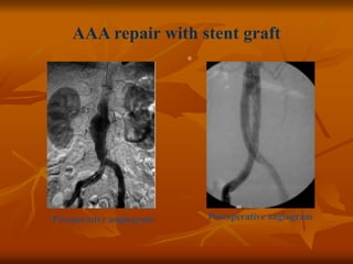Preoperative angiogram Postoperative angiogram
®
AAA repair with stent graft
 
