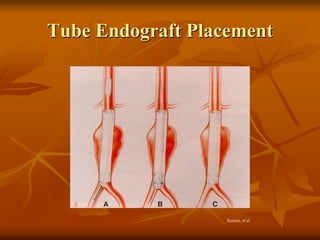 Tube Endograft Placement
Katzen, et al
 