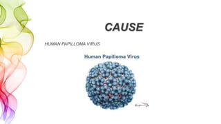 CAUSE
HUMAN PAPILLOMA VIRUS
 