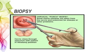 BIOPSY
 