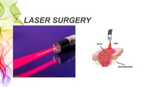 LASER SURGERY
 