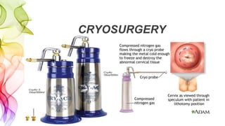 CRYOSURGERY
 