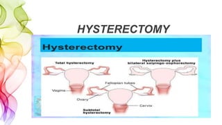 HYSTERECTOMY
 