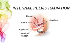 INTERNAL PELVIC RADIATION
 
