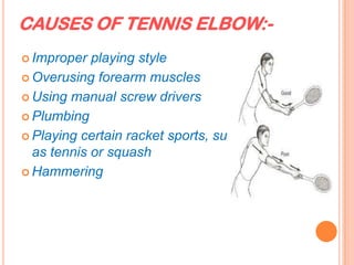CAUSES OF TENNIS ELBOW:-
 Improper playing style
 Overusing forearm muscles
 Using manual screw drivers
 Plumbing
 Playing certain racket sports, such
as tennis or squash
 Hammering
 