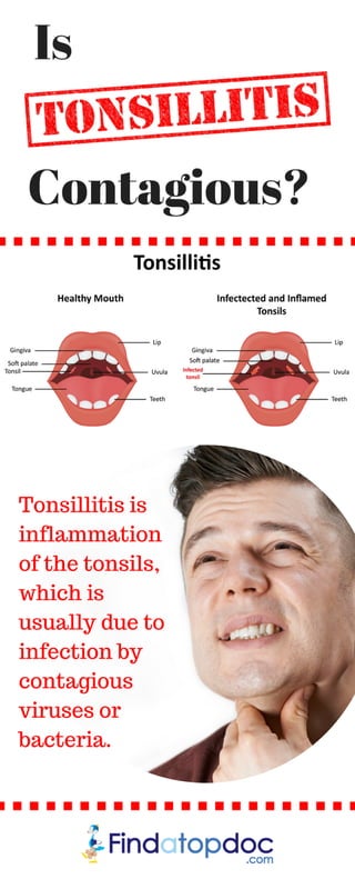 Is Tonsillitis Contagious?