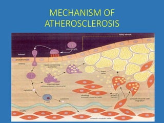 MECHANISM OF
ATHEROSCLEROSIS
 