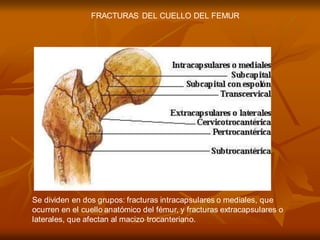 Se dividen en dos grupos: fracturas intracapsulares o mediales, que
ocurren en el cuello anatómico del fémur, y fracturas extracapsulares o
laterales, que afectan al macizo trocanteriano.
FRACTURAS DEL CUELLO DEL FEMUR
 
