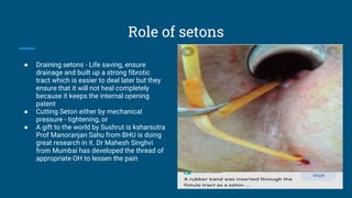 Seton Definition Understanding_the_fistula_in_ano_and_management_till_date.pptx