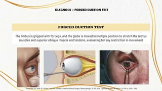JR - - - - Blow Out Fracture - AL....pptx