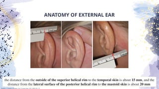 Journal Reading of Otoplasty evaluation and mangement | PPTX