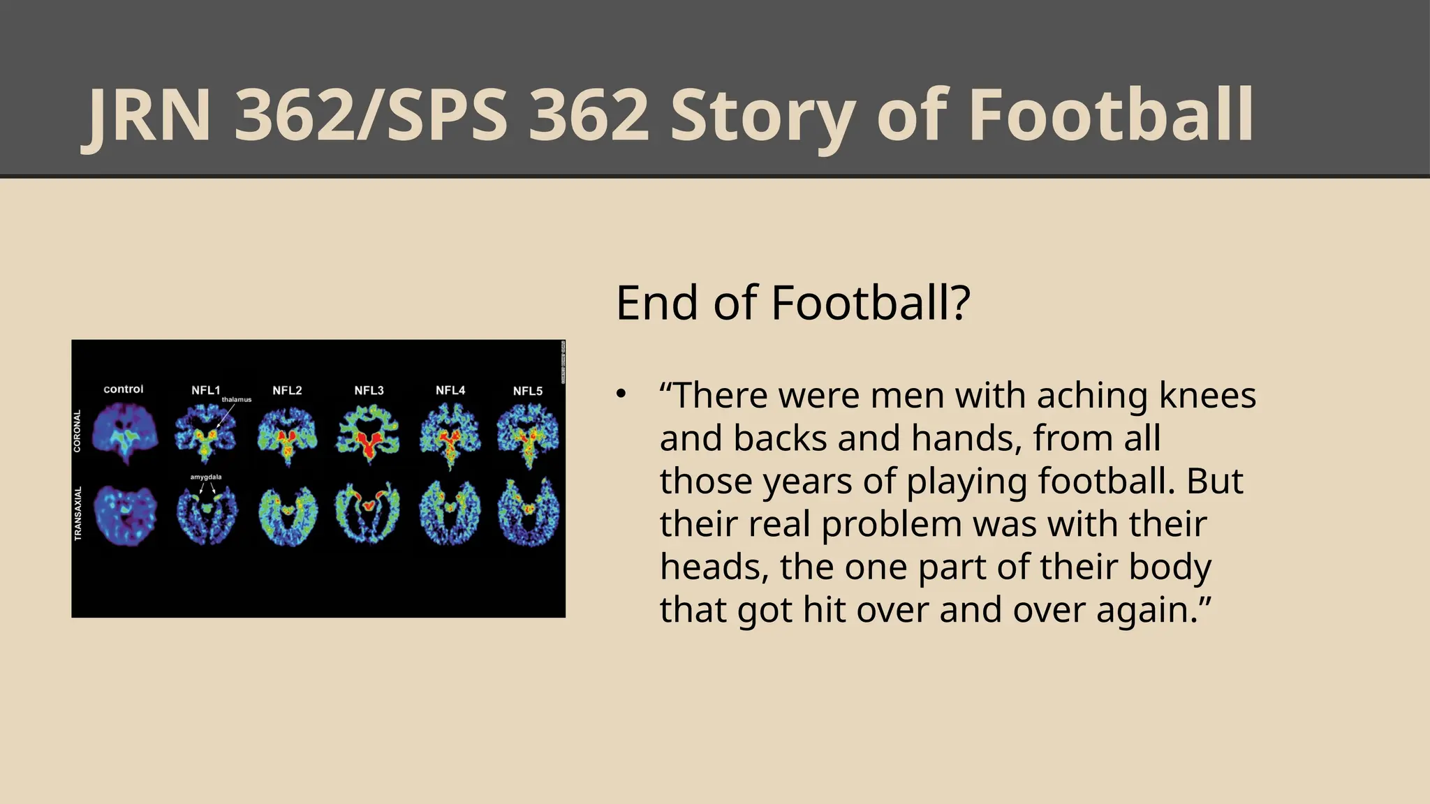 JRN 362/SPS 362 Story of Football
End of Football?
• “There were men with aching knees
and backs and hands, from all
those years of playing football. But
their real problem was with their
heads, the one part of their body
that got hit over and over again.”
 