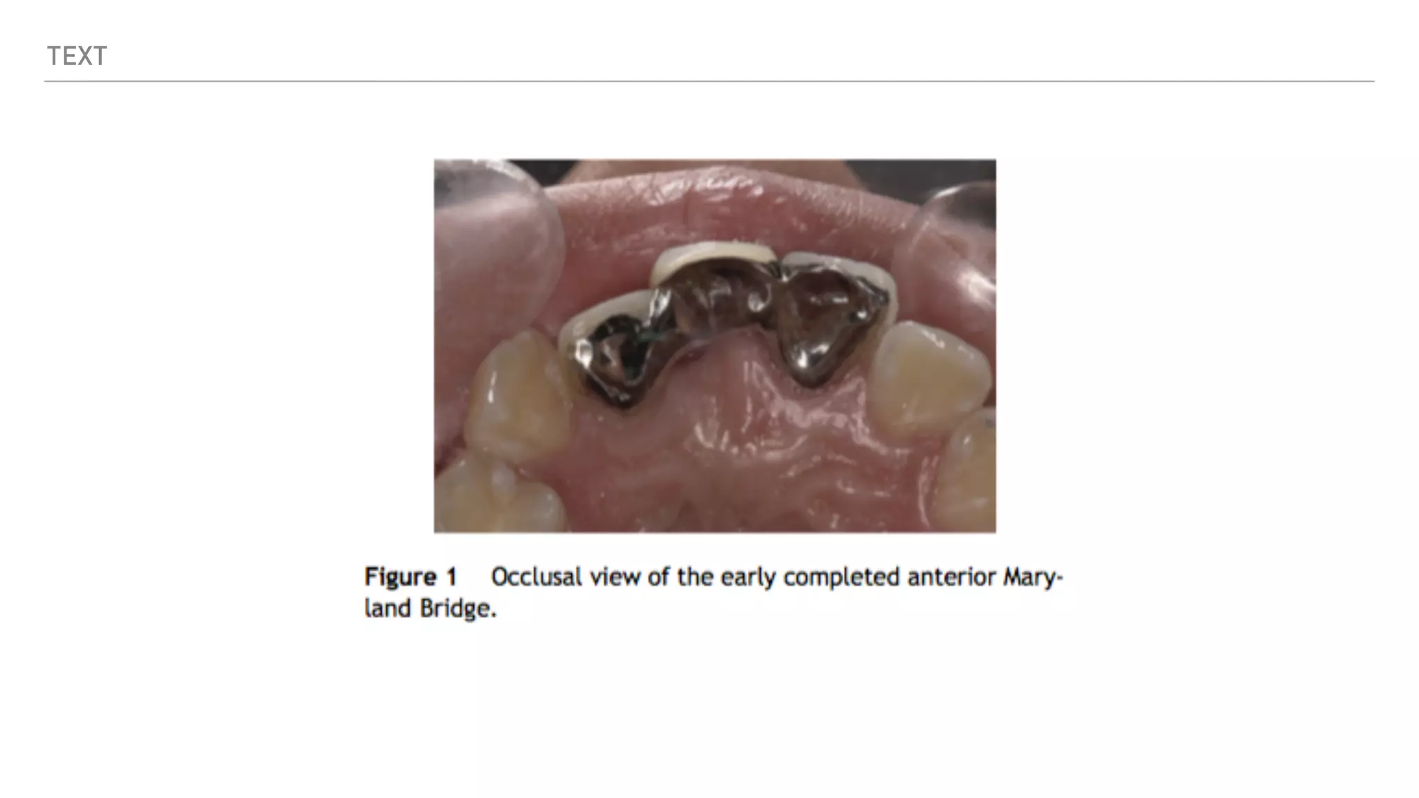 Prosthodontics: Maryland Bridge | PDF