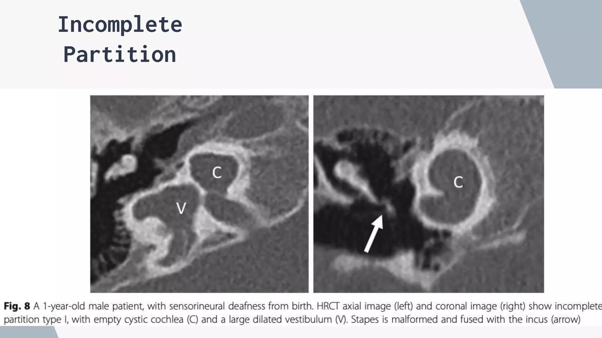 Pre post operative imaging of cochlear implant.pptx