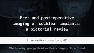 Pre- and post-operative
imaging of cochlear implants:
a pictorial review
Intan Kartika Nursyahbani, MD
Otorhinolaryngology Head and Neck Surgery Department
 