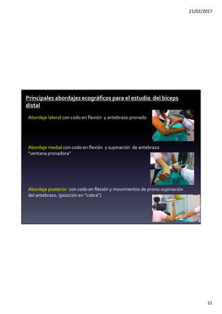 21/02/2017
11
Abordaje lateral con codo en flexión y antebrazo pronado
Abordaje medial con codo en flexión y supinación de antebrazo
“ventana pronadora”
Abordaje posterior con codo en flexión y movimientos de prono-supinación
del antebrazo. (posición en “cobra”)
Principales abordajes ecográficos para el estudio del bíceps
distal
 