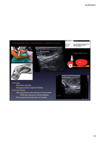 21/02/2017
12
Abordaje lateral con codo en flexión y antebrazo pronado.
Supinador
Extensores
Eur. Radiol (2009) 19:1817-1821
•Ventajas:
•Paciente cómodo.
•Se aprecia bien el patrón fibrilar.
•Inconvenientes:
•Haz ultrasónico atenuado por el supinador
•Dificulta valoración fibras distales.
•No se aprecia la inserción en el radio.
 