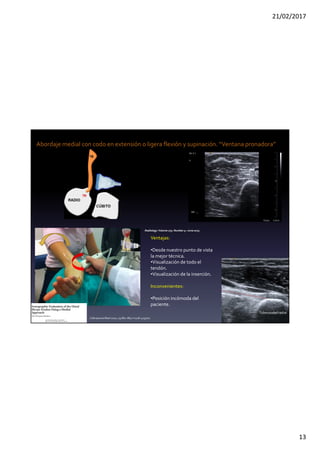 21/02/2017
13
Abordaje medial con codo en extensión o ligera flexión y supinación. “Ventana pronadora”
J Ultrasound Med 2010; 29:861–865 • 0278-4297/10
Ventajas:
•Desde nuestro punto de vista
la mejor técnica.
•Visualización de todo el
tendón.
•Visualización de la inserción.
Inconvenientes:
•Posición incómoda del
paciente.
PC
PL
Tuberosidadradial
Radiology:Volume 275: Number 3—June2015
 