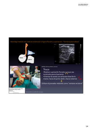 21/02/2017
14
Truco:
•Realizar supinación forzada aunque sea
incómodo para el paciente.
•Orientar la sonda con el borde distal de la
misma hacia el quinto dedo. (hacia externo)
Utilizar el pronador redondo como “ventana acústica”
J Ultrasound Med 2010; 29:861–865 • 0278-4297/10
Radiology:Volume 275: Number 3—June2015
Abordaje medial con codo en extensión o ligera flexión y supinación. “Ventana pronadora”
 