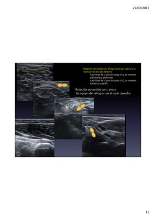 21/02/2017
15
PL PC
PL
PC
Rotación del tendón del bíceps distal 90º previo a su
inserción en el codo derecho
•Las fibras de la porción larga (PL), se insertan
proximales y profundas
•Las fibras de la porción corta (PC), se insertan
distales y superfici
PC
PL
Tuberosidadradial
Rotación en sentido contrario a
las agujas del reloj por ser el codo derecho
 