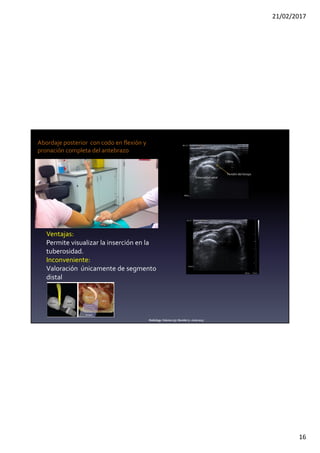 21/02/2017
16
Abordaje posterior con codo en flexión y
pronación completa del antebrazo
Ventajas:
Permite visualizar la inserción en la
tuberosidad.
Inconveniente:
Valoración únicamente de segmento
distal
Tuberosidad radial
Tendón del bíceps
Radiology:Volume 275: Number 3—June2015
Cúbito
 