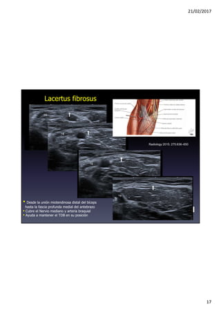 21/02/2017
17
Lacertus fibrosus
• Desde la unión miotendinosa distal del bíceps
hasta la fascia profunda medial del antebrazo
• Cubre el Nervio mediano y arteria braquial
• Ayuda a mantener el TDB en su posición
Dra. M. Miguel
LF
Radiology 2015; 275:636–650
TB
TB
TB
TB
LF
 
