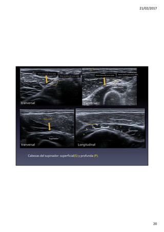 21/02/2017
20
Rama motoradel nervio radial
Rama sensitiva del nervio radial
Supinador
S
P
Rama motora
Supinador
Rama motora
Longitudinal
tranversal
tranversal
tranversal
braquiorradial
braquiorradial
Cabezas del supinador: superficial(S) y profunda (P).
Supinador
Rama motoradel nervio radial
Rama sensitiva del nervio radial
 