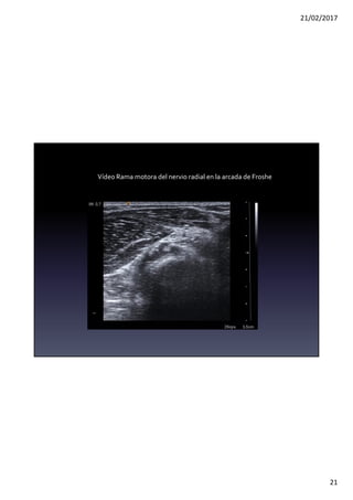 21/02/2017
21
Vídeo Rama motora del nervio radial en la arcada de Froshe
 