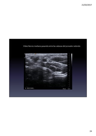21/02/2017
24
Vídeo Nervio mediano pasando entre las cabezas del pronador redondo
 