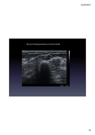 21/02/2017
29
Nervio Cubital pasando por el túnel cubital
 