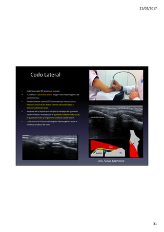 21/02/2017
31
Codo Lateral
Plica sinovial lateral
Epicóndilolateral
TEC
Cabeza radio
cóndilo
cabeza del radio
• Codo flexionado 90º antebrazo pronado
• “Landmark”: Epicóndilo lateral Imagen lineal hiperecogénica de
contornos lisos.
• Tendón Extensór común (TEC): Formado por Extensor corto,
Extensor común de los dedos, Extensor del quinto dedo y
Extensor cubital del carpo.
• Separado de la cápsula articular por el complejo del ligamento
colateral lateral: Formado por el ligamento colateral radial (LCR),
el ligamento anular y el ligamento colateral cubital lateral.
• La plica sionvial: Esturctura triangular hiperecogénica entre el
cóndilo y la cabeza del radio
Dra. Silvia Martinez
 
